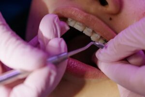 What to Expect When Getting Adult Braces